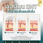 ฮอร์โมน DHT คืออะไร ทำให้ผมร่วงผมบางได้อย่างไร