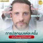 การปลูกผมแต่ละครั้งสามารถปลูกได้กี่กราฟต์