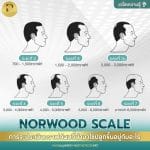 การจะประเมิณกราฟผมที่นำมาใช้ปลูกขึ้นอยู่กับอะไร (Norwood Scale)