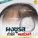 ผงชูรส ทำให้ ผมร่วง?