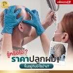 รู้หรือไม่ ราคาปลูกผม ขึ้นอยู่กับอะไรบ้าง?