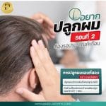 อยากปลูกผมรอบสองต้องรอกี่เดือน