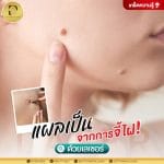 แผลเป็นจากการจี้ไฝด้วยเลเซอร์