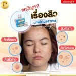 ลดปัญหาเรื่องสิวด้วย ฉีดมาเด้ คอลลาเจน (made collagen)