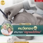 คนวัยทองสามารถปลูกผมได้ไหม