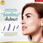 ร้อยไหมเจ็บไหม?