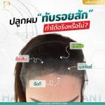ปลูกผมทับรอยสักทำได้จริงหรือไม่ (Does hair transplant hurt?)