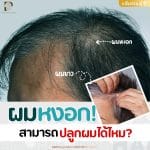 ผมหงอกสามารถปลูกผมได้ไหม (Gray hair can be make hair transplant ?)