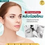 วิธีการดูแลหลังร้อยไหม