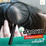 ปลูกผมทับรอยแผลเป็น ผมจะขึ้นมั้ย