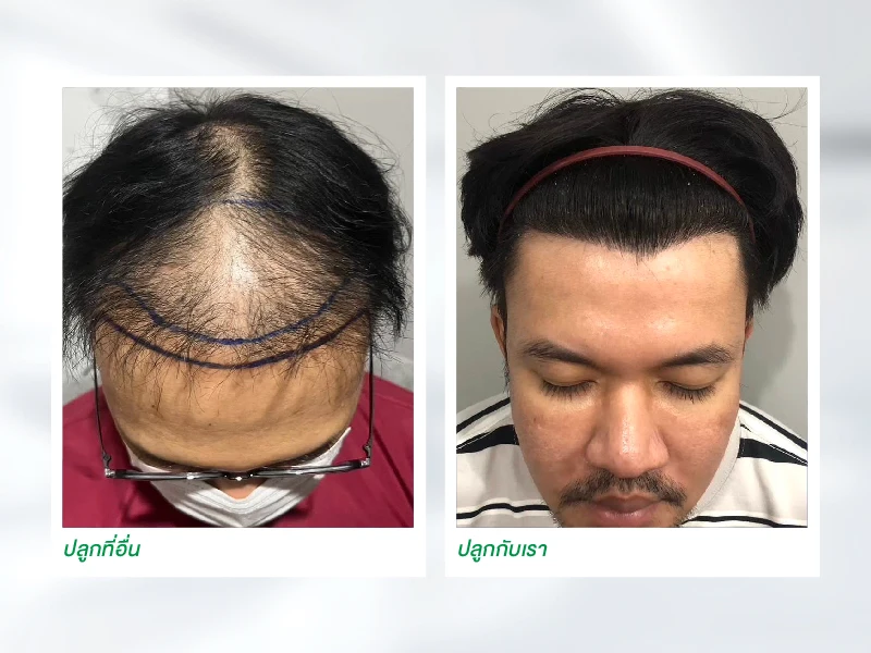 ความเสี่ยงของการปลูกผม
