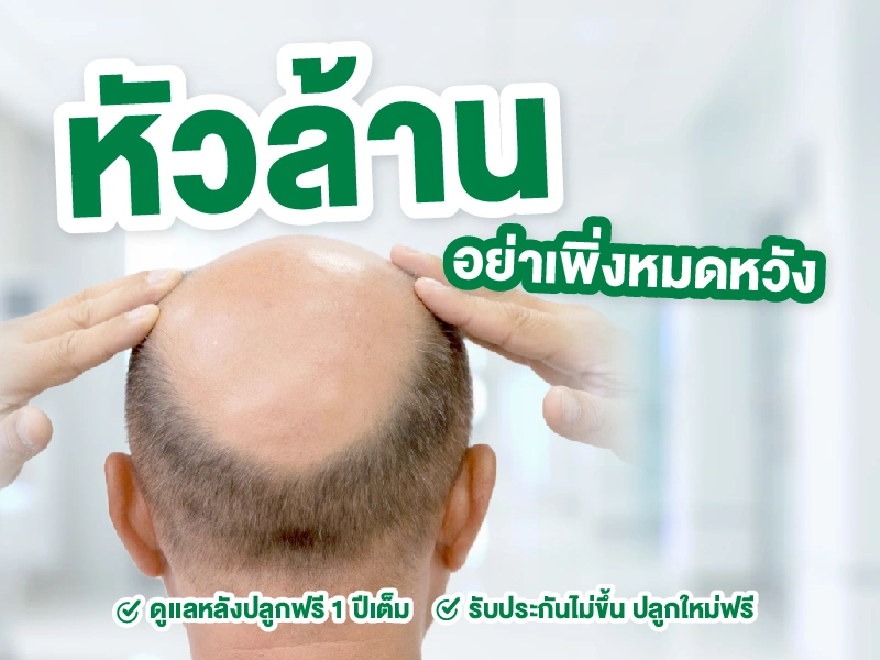 ปลูกผมราคาดี แก้หัวล้าน