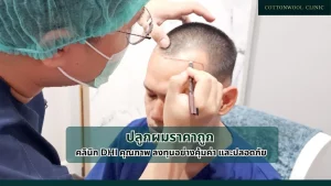 ปลูกผมราคาถูก คลินิก DHI