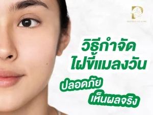 วิธีกําจัดไฝขี้แมลงวัน