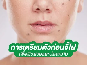 เตรียมตัวก่อนจี้ไฝ