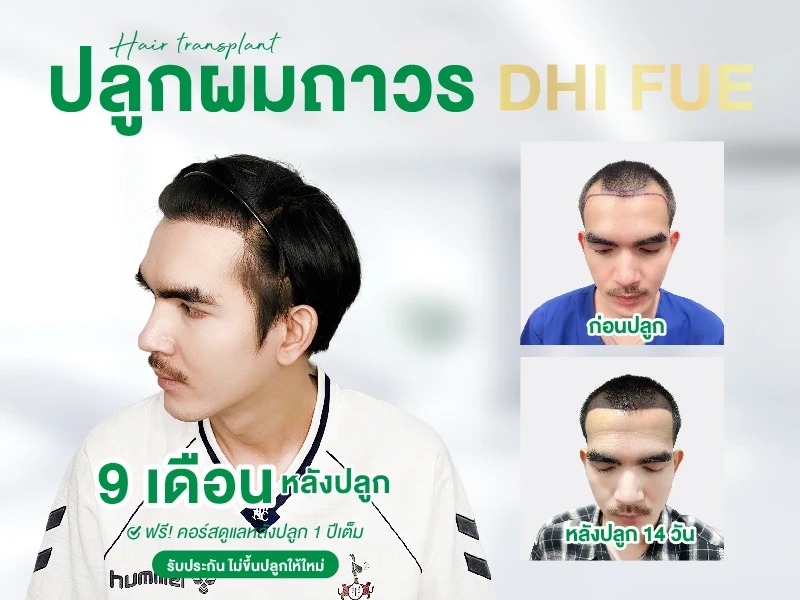 โปรโมชั่นปลูกผมถาวร