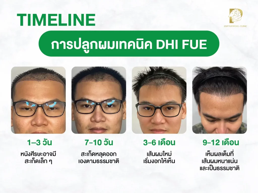 ขั้นตอนปลูกผมเทคนิค DHI