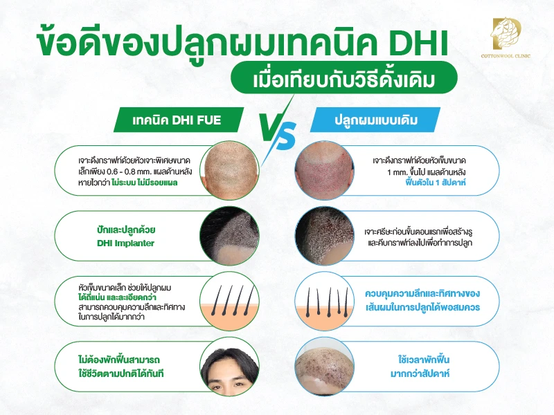 ข้อดีปลูกผมเทคนิค DHI