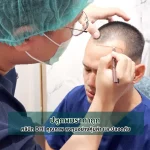 ปลูกผมราคาถูก คลินิก DHI คุณภาพ ลงทุนอย่างคุ้มค่าและปลอดภัย