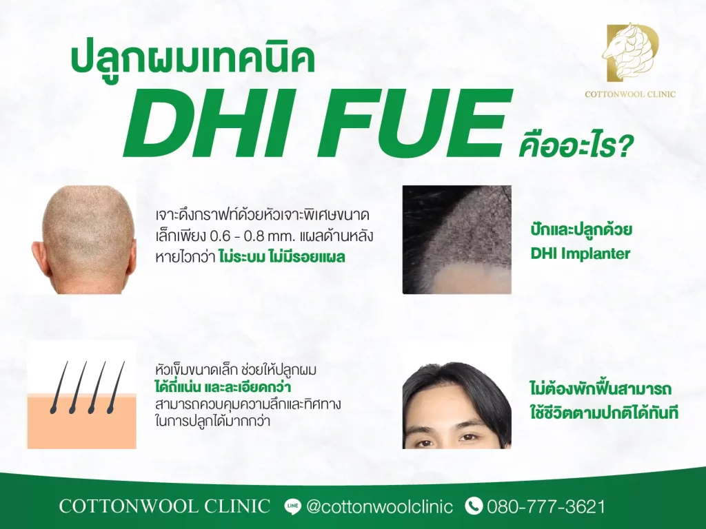 ปลูกผมเทคนิค DHI คือ