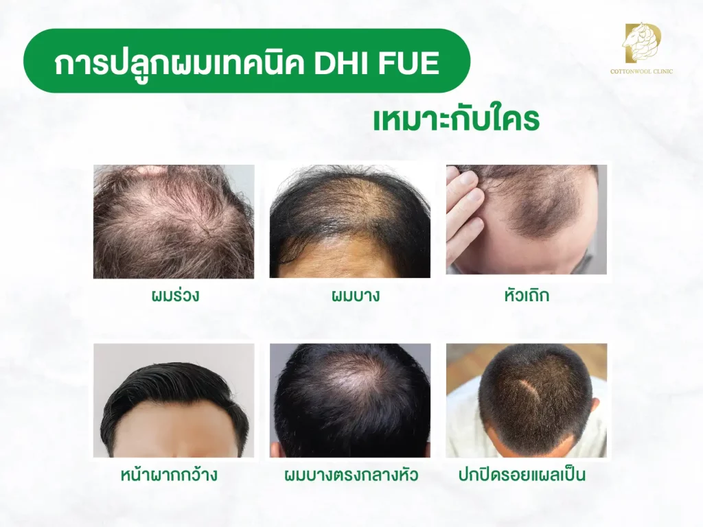 ปลูกผมเทคนิค DHI