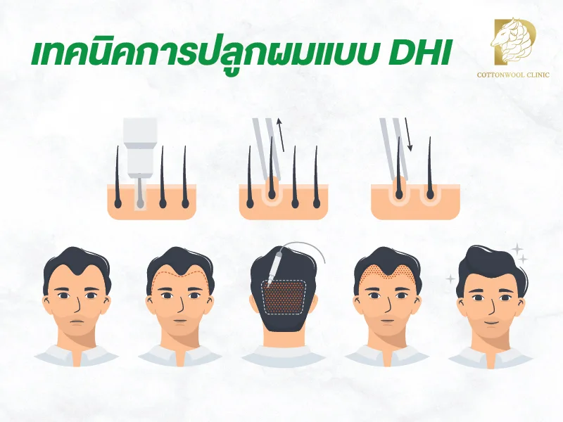 ขั้นตอนการปลูกผมแบบ DHI