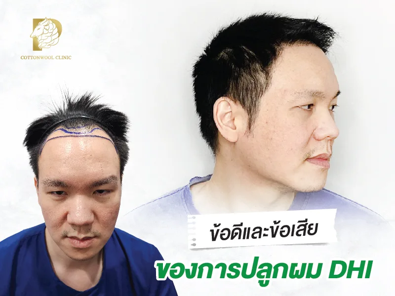 ข้อดีและข้อเสียของการปลูกผม DHI