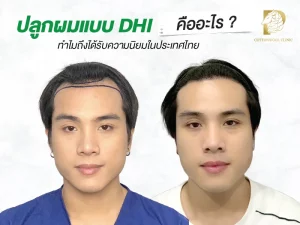 ปลูกผมแบบ DHI คืออะไร