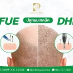 เลือกไม่ถูกระหว่างปลูกผม FUE กับ DHI? รวมข้อแตกต่างที่ควรรู้ก่อนตัดสินใจ
