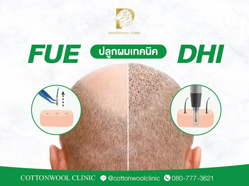 ปลูกผมแบบ FUE และ DHI เปรียบเทียบความแตกต่างของเทคนิคการย้ายกราฟต์ผม