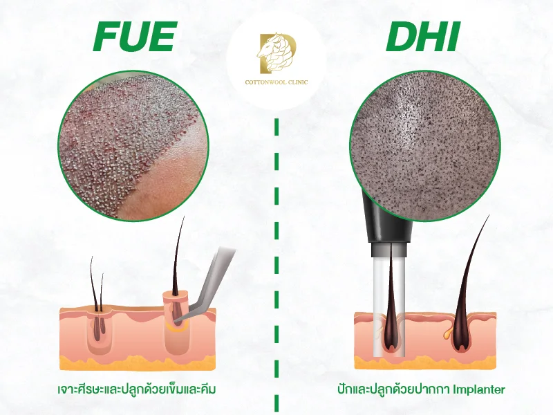 เทคนิคการปลูกผม FUE กับ DHI