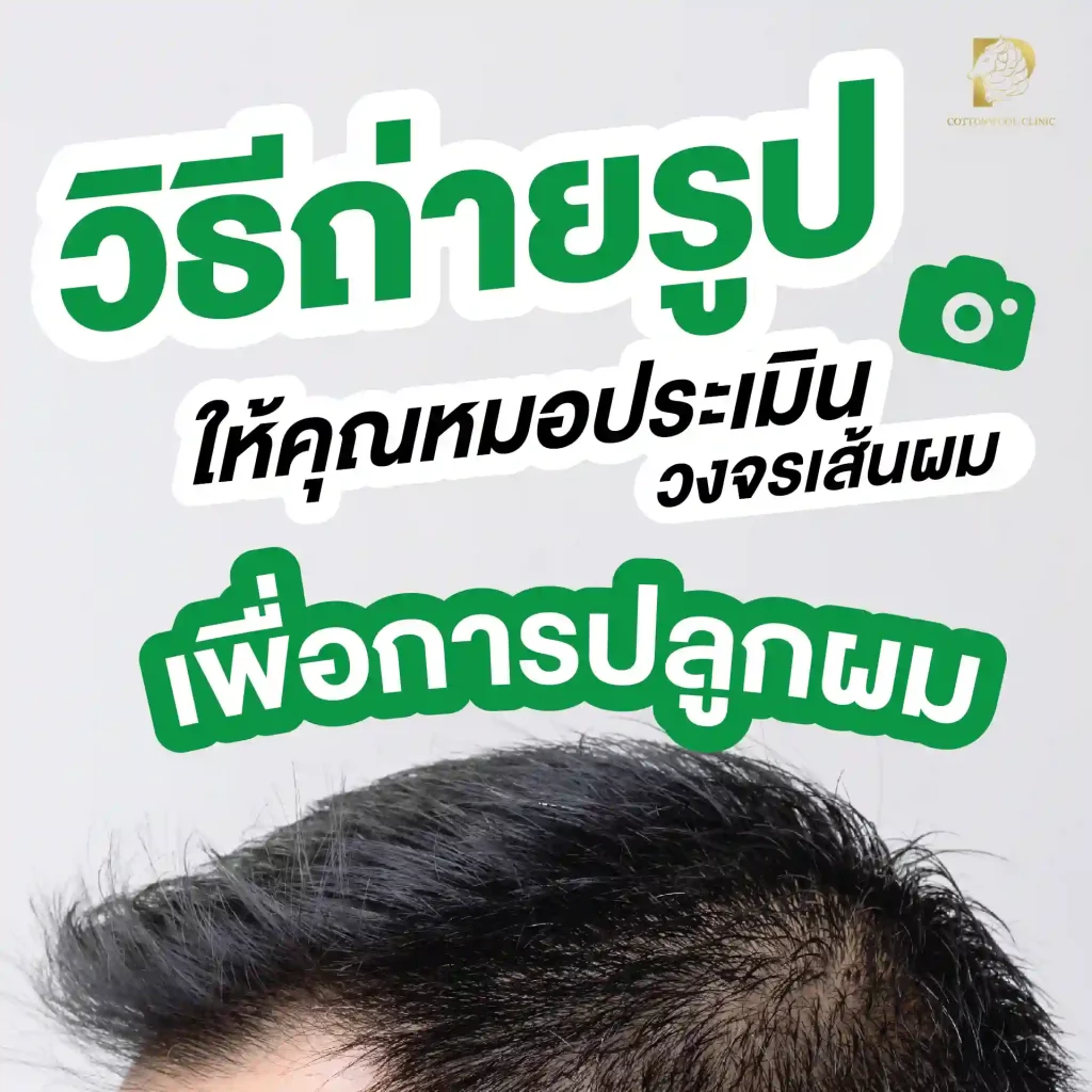 ถ่ายรูปเพื่อให้คุณหมอประเมินวงจรเส้นผม เพื่อการปลูกผมได้อย่างแม่นยำ