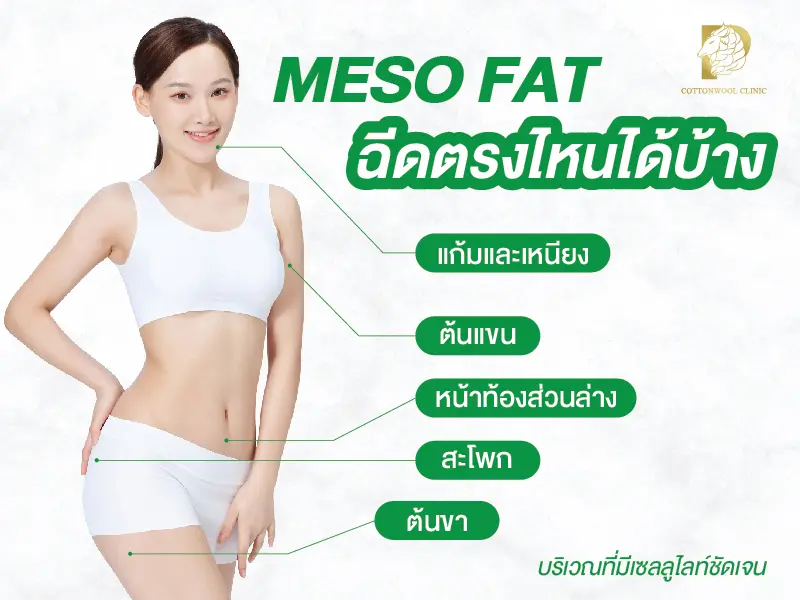 Mesofat คือ การฉีดสารสลายไขมันเข้าสู่ชั้นไขมันใต้ผิวหนัง เพื่อลดไขมันเฉพาะจุด เช่น แก้ม เหนียง หรือหน้าท้อง โดยช่วยให้ไขมันแตกตัวและถูกขับออกจากร่างกายอย่างเป็นธรรมชาติ